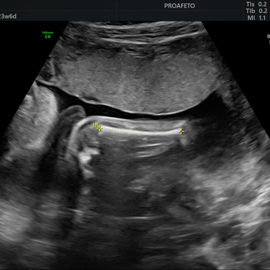 Ultrassom Morfológico de 2º Trimestre Pró Afeto